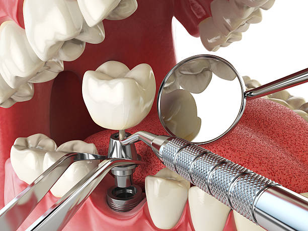 Best Urgent Tooth Repair  in New Burlington, OH